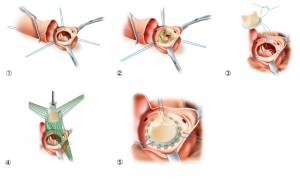 生体弁を用いた大動脈弁置換術の手順（①～⑤）