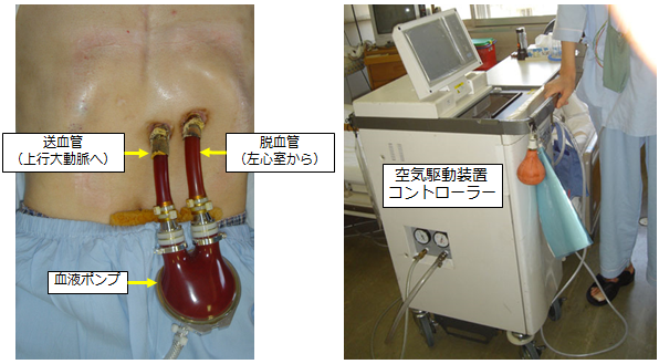 体外設置型人工心臓