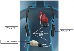 植え込み型人工心臓の小型化