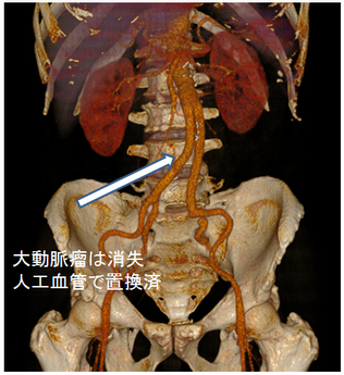 人工血管置換術後