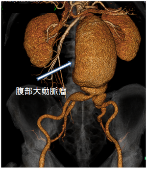 人工血管置換術前