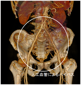 腹部大動脈閉塞症例に対する大動脈-両側大腿動脈バイパス術（人工血管使用）