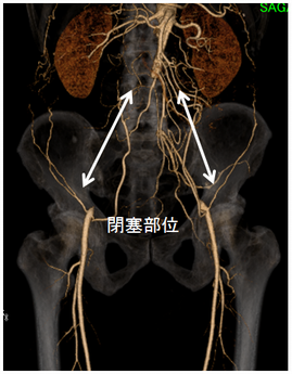 腹部大動脈閉塞症例に対する大動脈-両側大腿動脈バイパス術（人工血管使用）