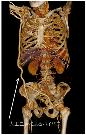 腋窩—大腿動脈バイパス術