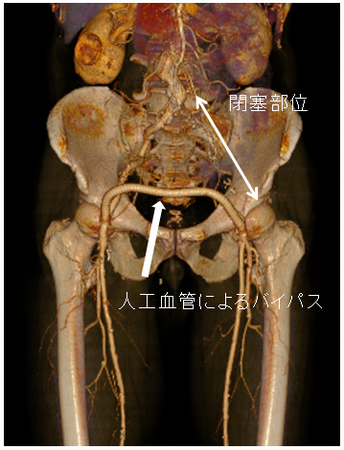 左腸骨動脈閉塞症例に対する大腿動脈－大腿動脈バイパス術