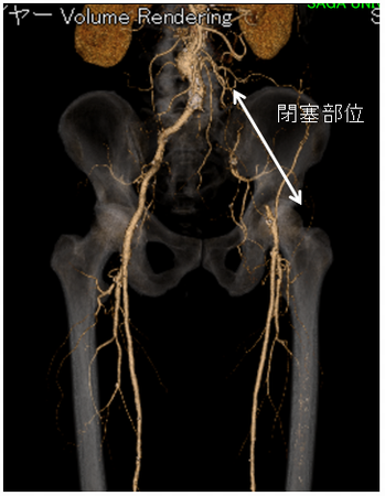 左腸骨動脈閉塞症例に対する大腿動脈－大腿動脈バイパス術