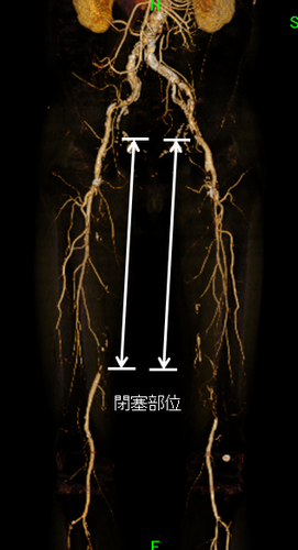 両側浅大腿動脈閉塞に対する両側大腿動脈-膝窩動脈バイパス術（人工血管使用）