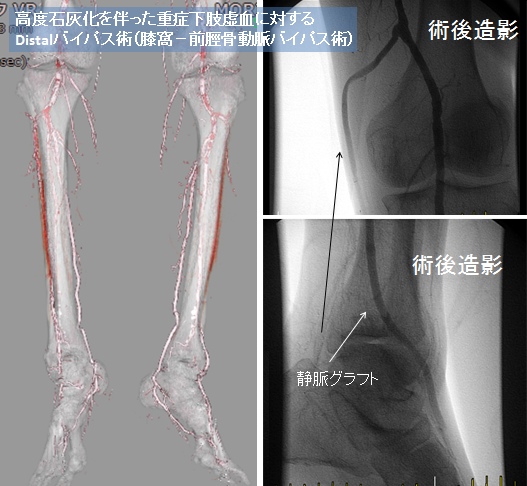 重症下肢虚血に対する血行再建術