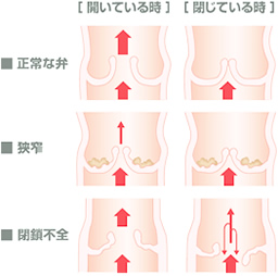 図2. 出展「エドワーズライフサイエンス社運営のサイトより転載」